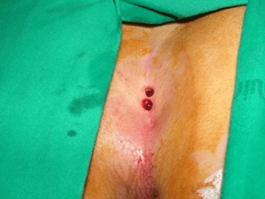 immagine cisti miniinvasiva